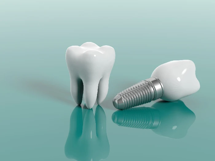Dental Implants